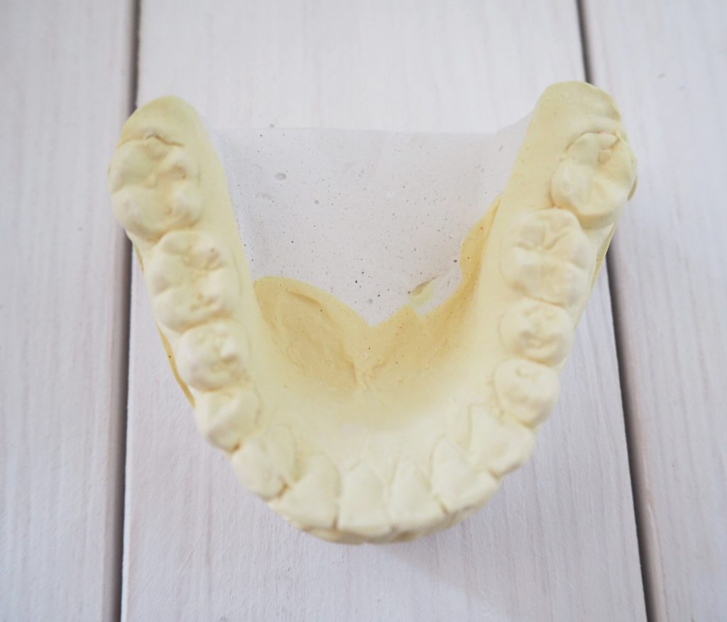 Moje leczenie ortodontyczne + wybielanie zębów metodą gabinetową